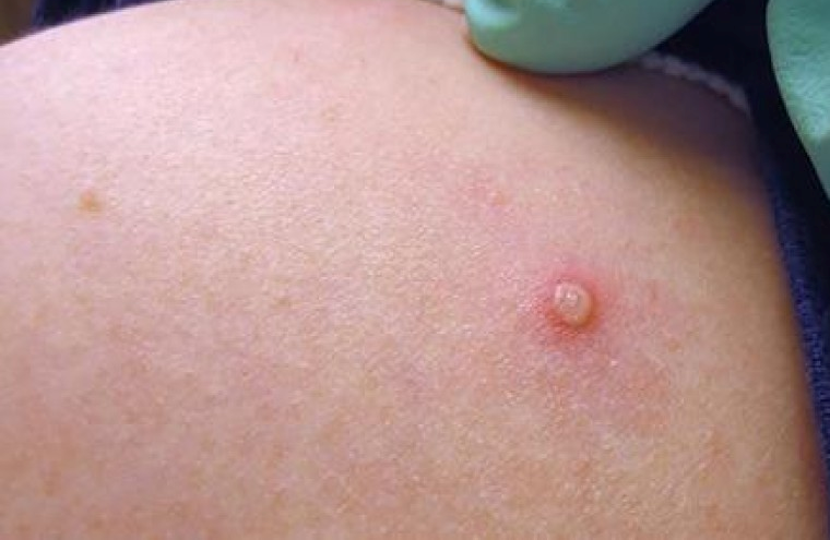 मङ्कीपक्सको जोखिम रहेकोले सचेत रहन स्वास्थ्य मन्त्रालयको आग्रह