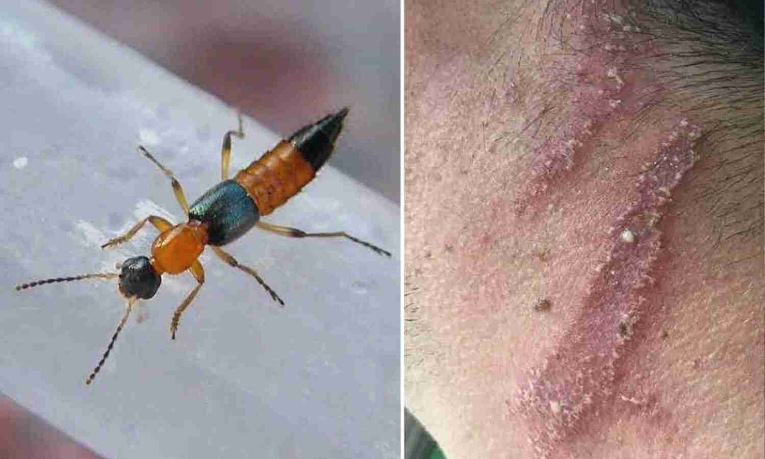 झापाको तीन पालिकामा ‘नाइरोबी फ्लाइ’का सङ्क्रमित फेला,१०० जना स्वास्थ्यकर्मीहरुको सम्पर्कमा