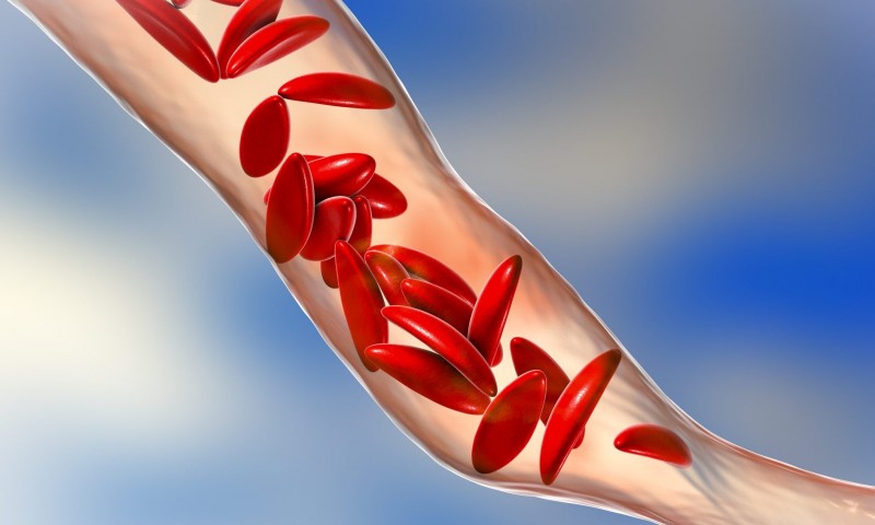 रुपन्देहीमा सिकलसेलका बिरामी बढे