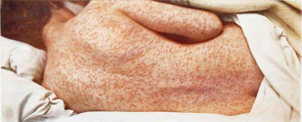 दक्षिण अफ्रिकामा दादुरा सङ्क्रमित बढे